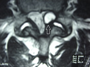 synovial cyst